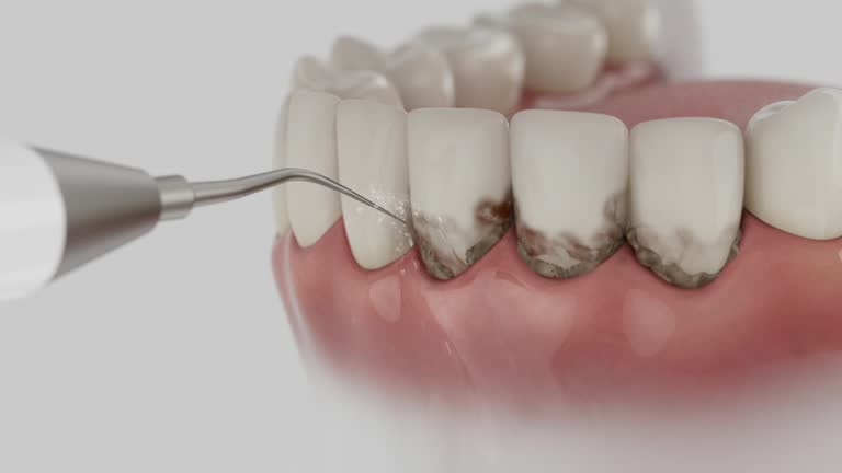 Reliable Dental Implants contractor in Fort Pierre, SD by Smile Center Dentistry